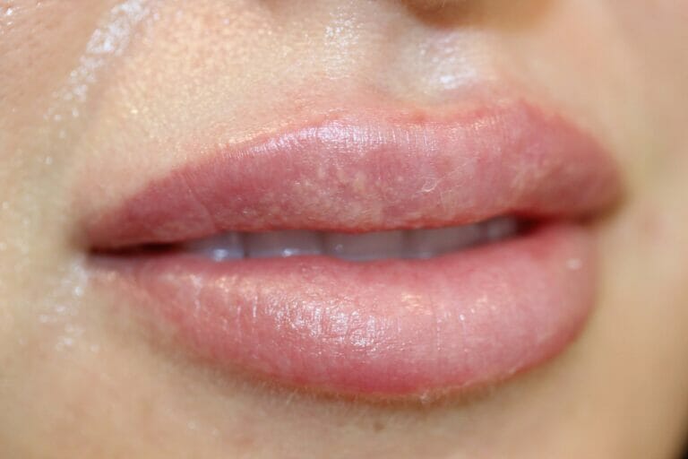 Permanent Lip Liner Before And After Photos