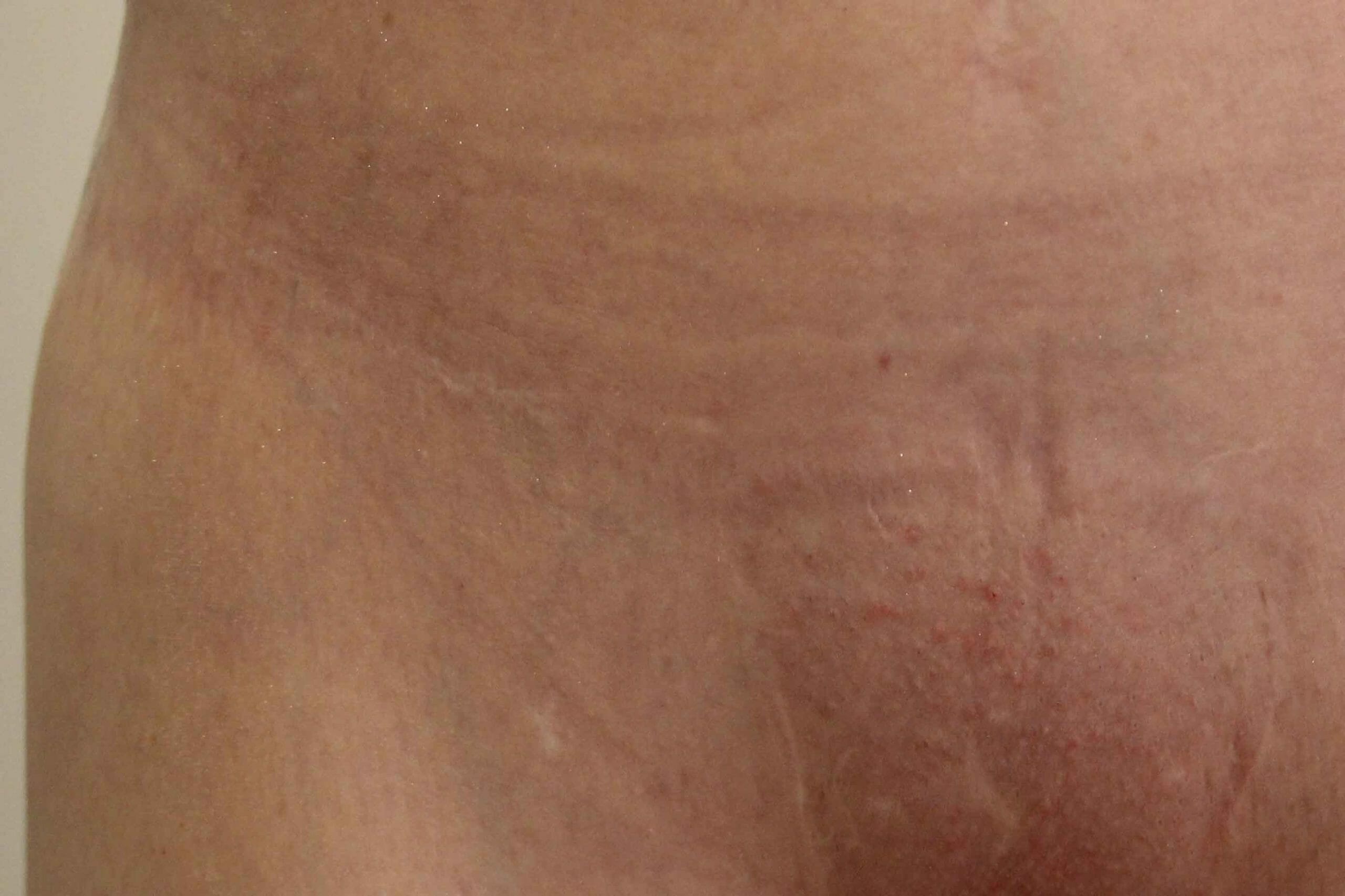 Scar Camouflage Tattoo Before and After  Ruth Swissa
