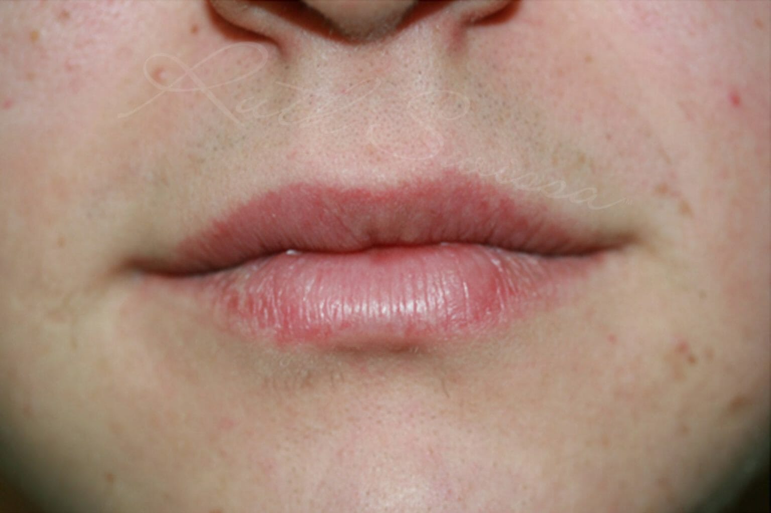 Permanent Lip Liner Before and After Photos - Ruth Swissa