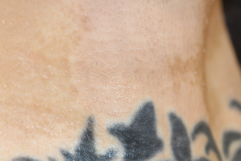 Ruth Swissa Scar Camouflage Medical tattooing Discoloration