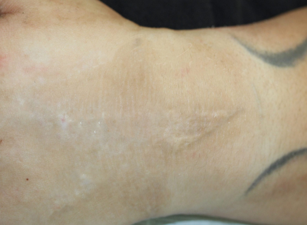 Ruth Swissa Scar Camouflage Medical tattooing Discoloration