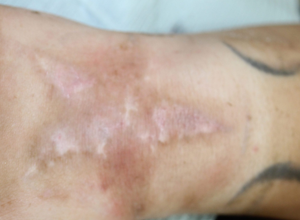 Ruth Swissa Scar Camouflage Medical tattooing Discoloration