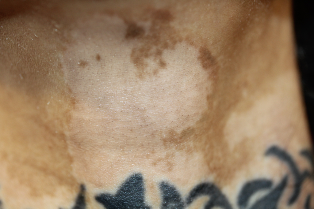 Ruth Swissa Scar Camouflage Medical tattooing Discoloration